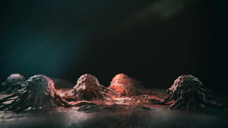 En sık görülen kanser türlerinden biri! Eğer ayağınızda bu değişim varsa... 2