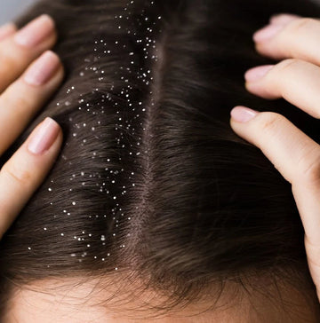 Mutfağınızdaki bu ürün sayesinde kepek sorunu tarihe karışıyor! Mucizevi bir şey! Uygulayanlar, dua edecek 2