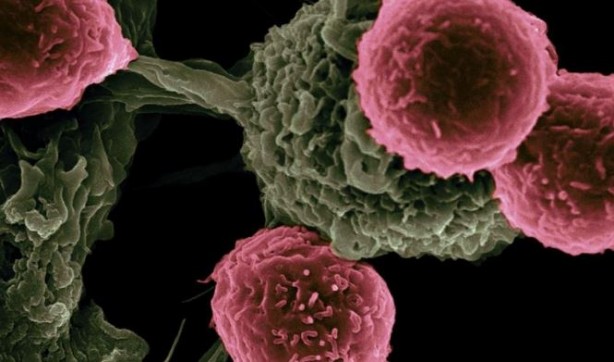 En erken evre kanser belirtileri açıklandı! Zamanlama hayat kurtarıyor 9