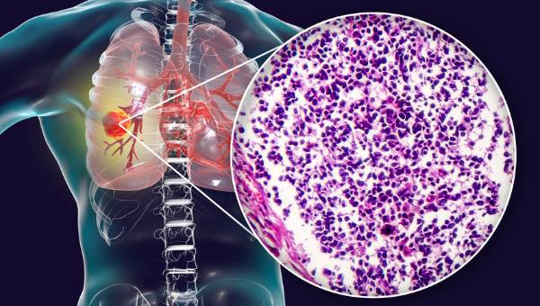 Akciğer kanserinin ilk belirtisi sabah ortaya çıkıyor! Uyandığınız anda bunu yaşıyorsanız... 6