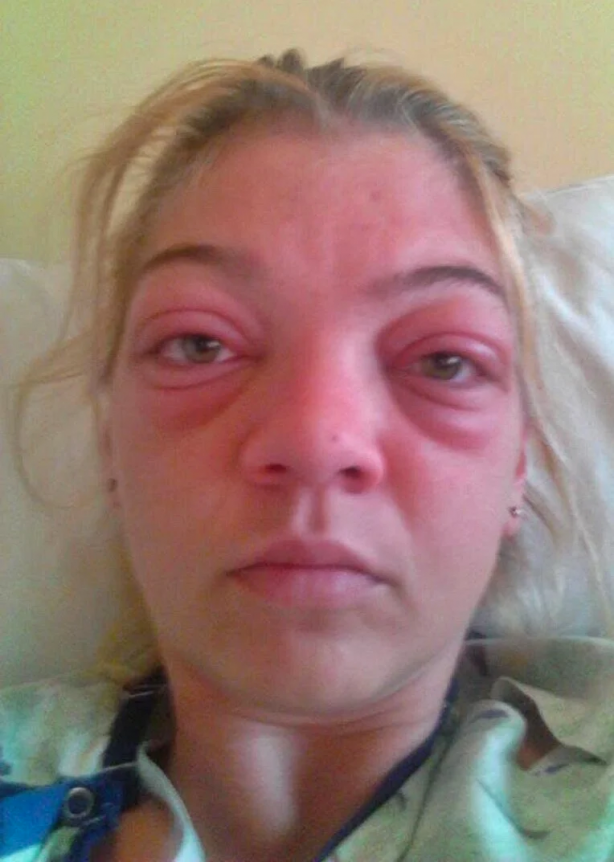 Gözleri yerinden çıkaran hastalığa dikkat! Uzmanı uyardı: Bu belirtiler varsa... 3