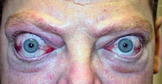 Gözleri yerinden çıkaran hastalığa dikkat! Uzmanı uyardı: Bu belirtiler varsa... 2