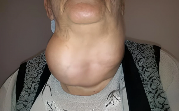 Gözleri yerinden çıkaran hastalığa dikkat! Uzmanı uyardı: Bu belirtiler varsa... 5