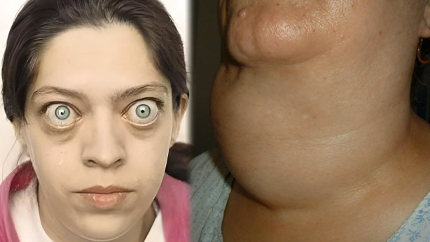 Gözleri yerinden çıkaran hastalığa dikkat! Uzmanı uyardı: Bu belirtiler varsa... 1