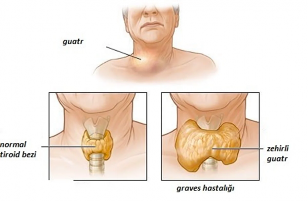 Gözleri yerinden çıkaran hastalığa dikkat! Uzmanı uyardı: Bu belirtiler varsa... 4