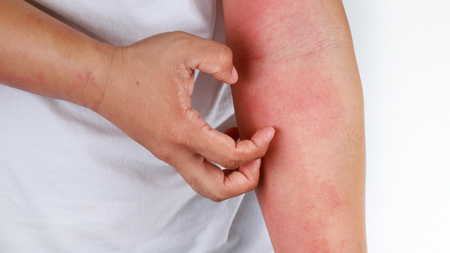 Kaşıntı ile ortaya çıkan bu hastalığa dikkat! Etkileri aylarca sürebiliyor... 6