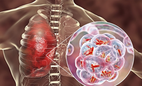 İşte ölüm oranı en hızlı artan hastalık... 1