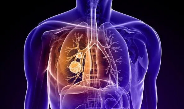 İşte ölüm oranı en hızlı artan hastalık... 3