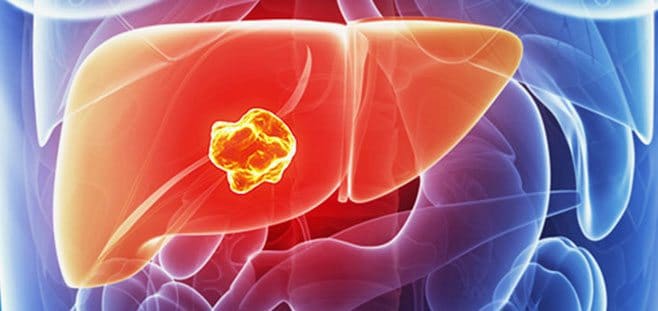 Sakın görmezden gelmeyin, kanserin uyarı veren 3 belirtisine dikkat! 1