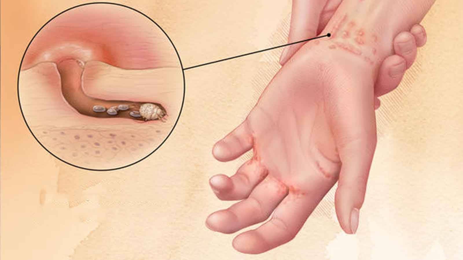 Kaşıntı ile ortaya çıkan bu hastalığa dikkat! Etkileri aylarca sürebiliyor... 3