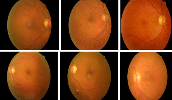 Basit bir hastalık deyip geçmeyin! Körlüğe götürüyor... 3