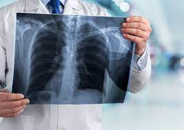 Bu belirti akciğerinizin sönmeye başladığını gösteriyor! Hemen bu testi yapın! 4