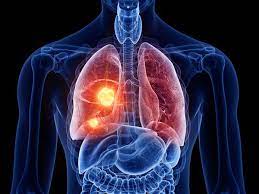 Bu belirti akciğerinizin sönmeye başladığını gösteriyor! Hemen bu testi yapın! 2