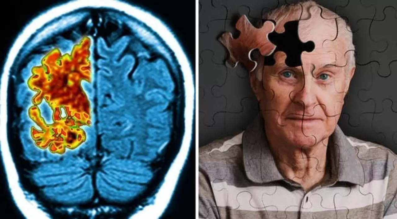 Sessiz tehlike: Beyin implantları bakterilere kapı aralıyor 4